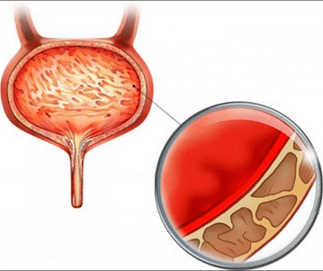 Inflamação da cistite