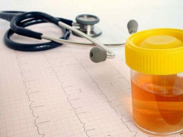 análise de urina para diagnosticar cistite